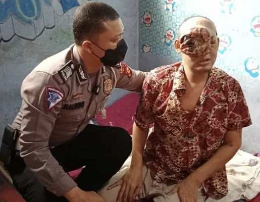 Tumor Ganas Hampir Menutup Semua Wajahnya, Polisi Membantu Carikan Pendonasi Tumor Ganas Hampir Menutup Semua Wajahnya, Polisi Bantu Mencarikan Pendonasi